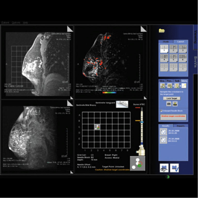 magnetom-BreVis-Biopsy