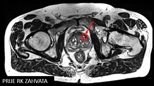 prostata ck55